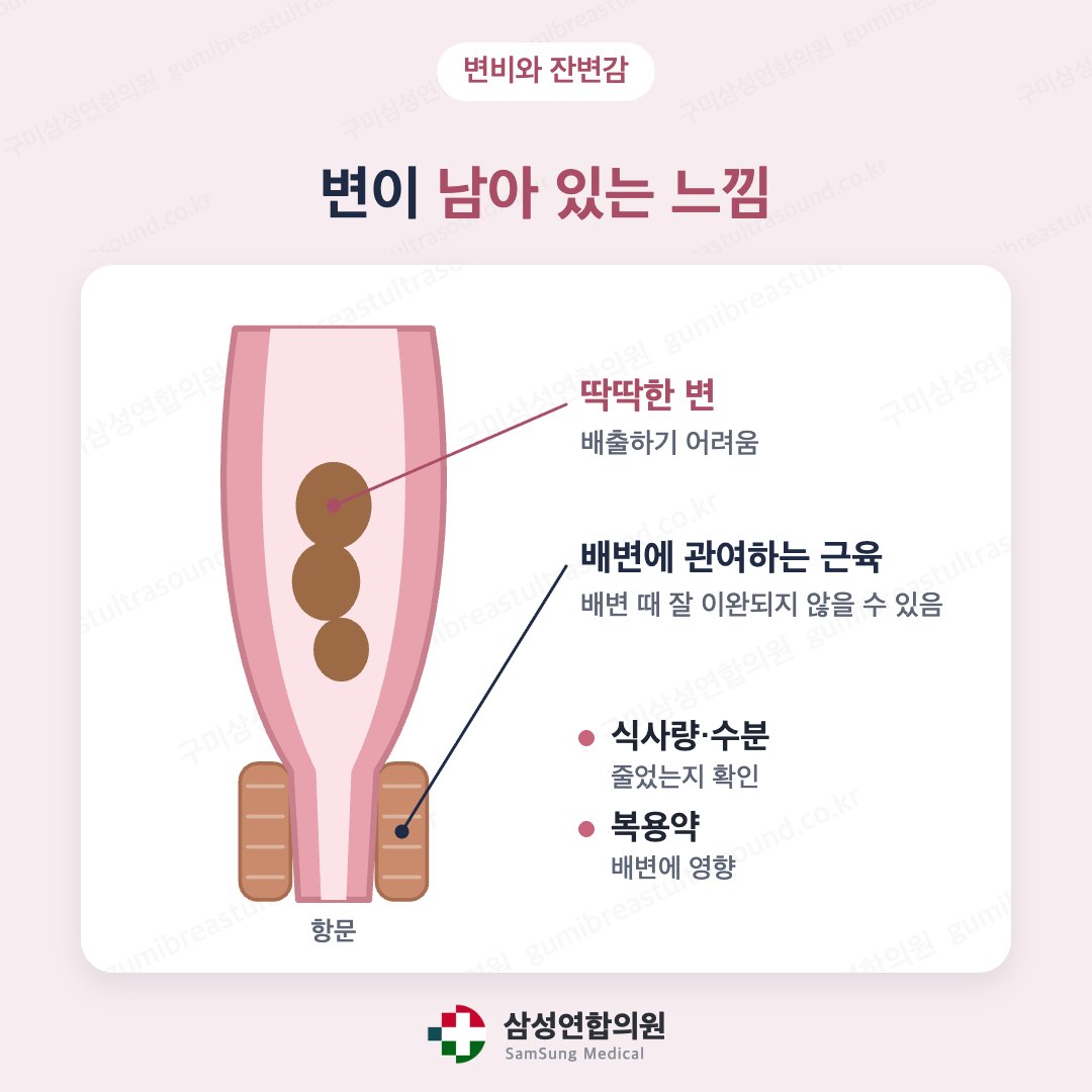 직장에 딱딱한 변이 남아 잔변감이 생기는 과정을 나타낸 의학 도식