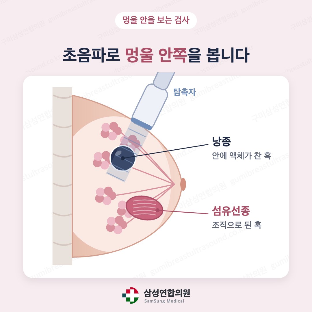 유방 단면에서 탐촉자로 낭종과 섬유선종을 보는 의학 도식