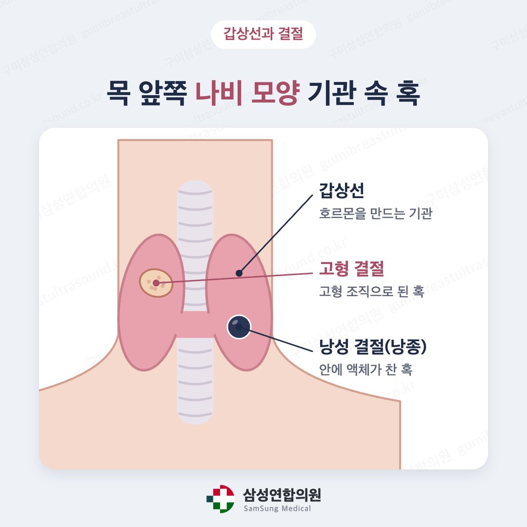 목 앞쪽 나비 모양 갑상선 안의 고형 결절과 낭성 결절(낭종)을 나타낸 의학 도식